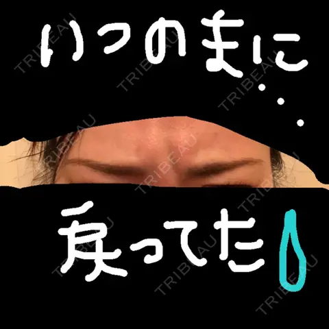 シワ取りボトックス 品川美容外科 千葉院 AFTER