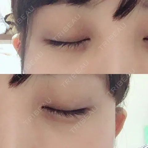 二重埋没 湘南美容クリニック 渋谷アネックス院 AFTER