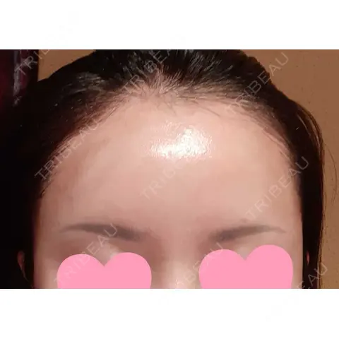 アートメイク（ヘアライン） トイトイトイクリニック 池袋院 DAY 1