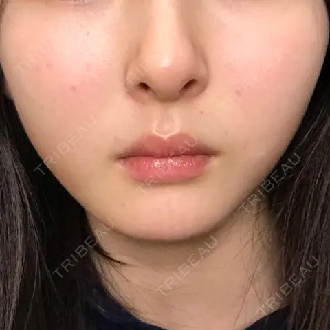 脂肪溶解注射（顔） 湘南美容クリニック 岡山院 AFTER
