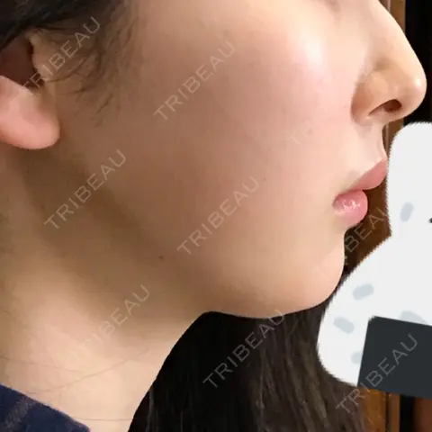 脂肪溶解注射（顔） 湘南美容クリニック 岡山院 AFTER
