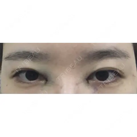 目頭切開 ラボム整形外科 DAY 0