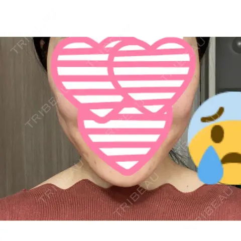 脂肪吸引（顔） アサミ美容外科 大阪院 AFTER