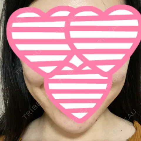 脂肪吸引（顔） アサミ美容外科 大阪院 AFTER