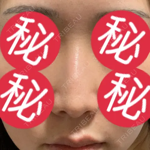 その他（鼻） 聖心美容クリニック 大阪院 AFTER