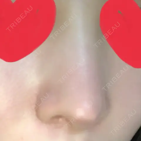 鼻尖形成（切開） / 鼻中隔延長（切開） / 小鼻縮小（切開） / 軟骨移植 / 鼻修正 リラ・クラニオフェイシャル・クリニック AFTER
