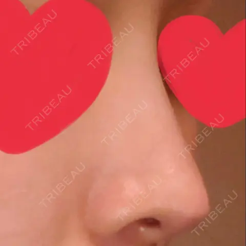 鼻尖形成（切開） / 鼻中隔延長（切開） / 小鼻縮小（切開） / 軟骨移植 / 鼻修正 リラ・クラニオフェイシャル・クリニック AFTER