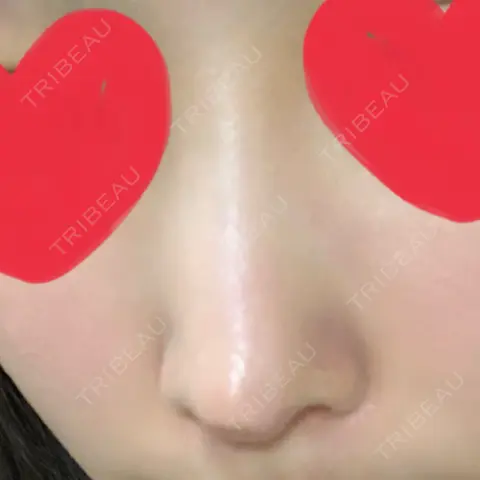 鼻尖形成（切開） / 鼻中隔延長（切開） / 小鼻縮小（切開） / 軟骨移植 / 鼻修正 リラ・クラニオフェイシャル・クリニック AFTER