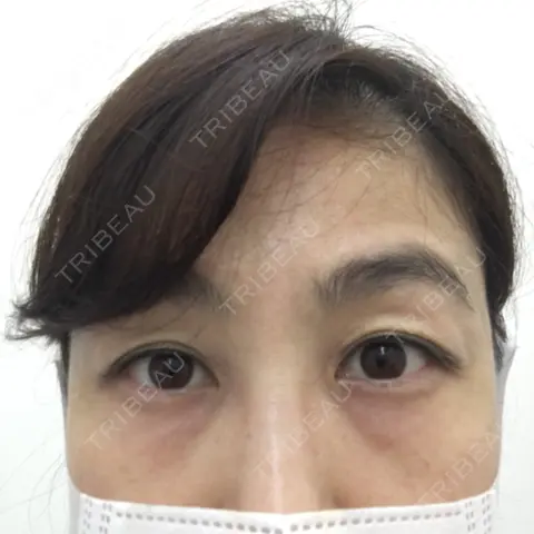 下まぶたの脂肪取り セオリークリニック AFTER