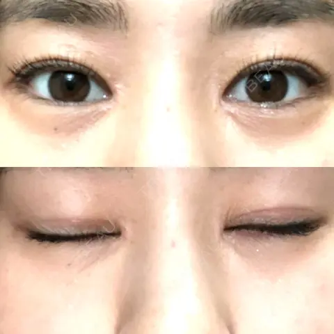 目頭切開 まりもクリニック AFTER
