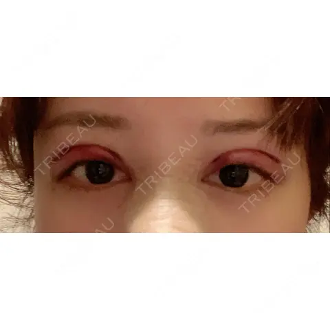 二重切開 / 上まぶたたるみ取り 酒井形成外科 DAY 0
