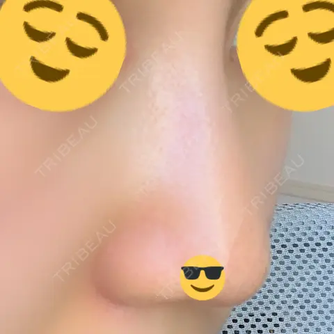 小鼻縮小（切開） / 軟骨移植 高須クリニック 名古屋院 AFTER