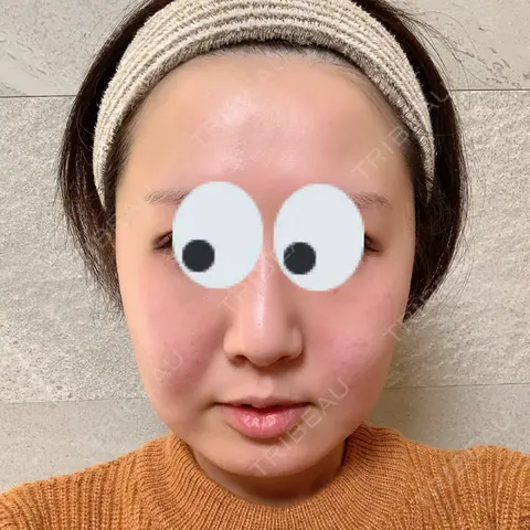 脂肪溶解注射（顔） Beauty Clinic the GINZA DAY 0