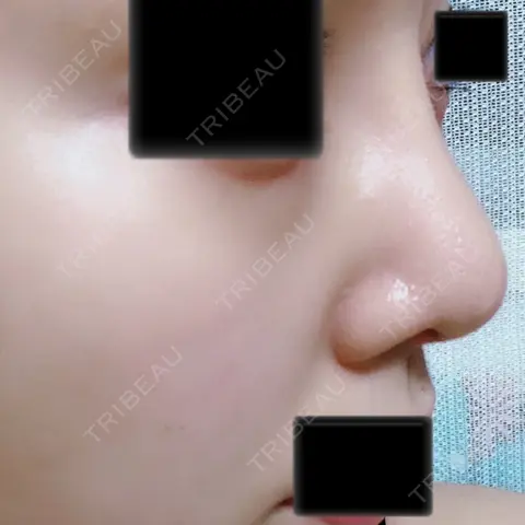 隆鼻術 / 鼻尖形成（切開） / 鼻中隔延長（切開） / 小鼻縮小（切開） / 軟骨移植 / 骨切幅寄せ / ワシ鼻修正・ハンプ切除 / 鼻修正 View美容整形外科 AFTER
