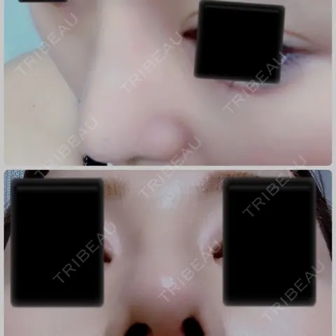 隆鼻術 / 鼻尖形成（切開） / 鼻中隔延長（切開） / 小鼻縮小（切開） / 軟骨移植 / 骨切幅寄せ / ワシ鼻修正・ハンプ切除 / 鼻修正 View美容整形外科 AFTER