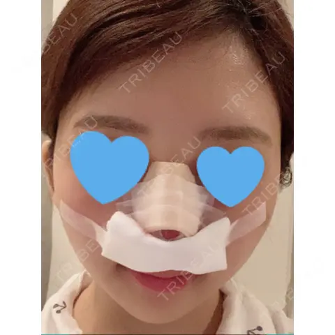 鼻尖形成（切開） / 軟骨移植 / 骨切幅寄せ THE ROPPONGI CLINIC（ザ 六本木クリニック） DAY 0