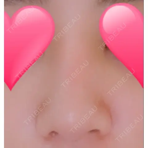 隆鼻術 / 軟骨移植 / 骨切幅寄せ id（アイディ）美容外科 AFTER