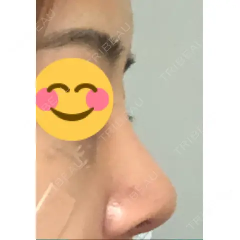 隆鼻術 / 軟骨移植 / 骨切幅寄せ id（アイディ）美容外科 AFTER