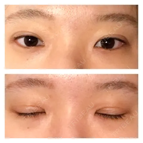 眼瞼下垂（切開） 蘇春堂形成外科 AFTER