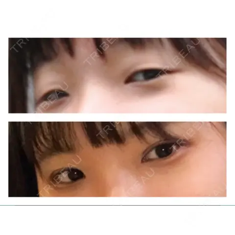 眼瞼下垂（切開） 蘇春堂形成外科 AFTER