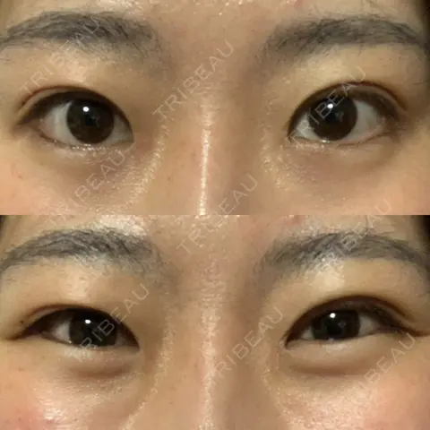 蒙古ひだ形成 R.O.clinic AFTER