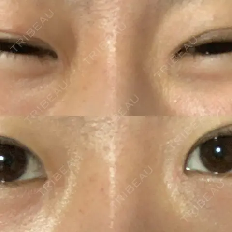 蒙古ひだ形成 R.O.clinic AFTER