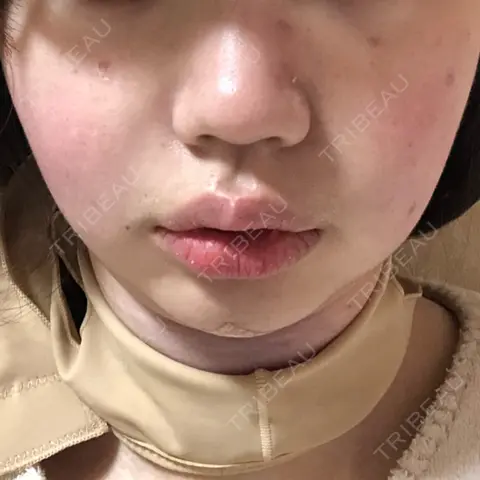 脂肪吸引（顔） WOM CLINIC GINZA （ワム クリニック ギンザ） DAY 0