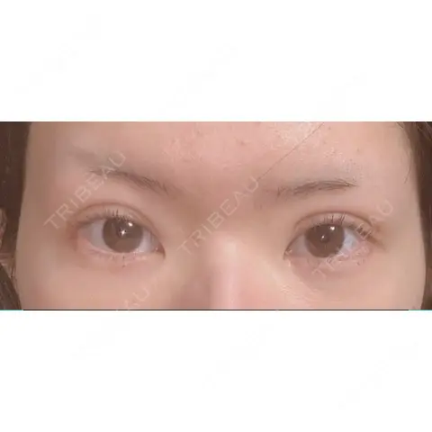 二重埋没 / ヒアルロン酸注入（涙袋） A CLINIC（エークリニック） 銀座院 DAY 0