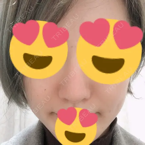 鼻尖形成（切開） / 小鼻縮小（切開） / 軟骨移植 グローバルビューティークリニック 大阪院 AFTER