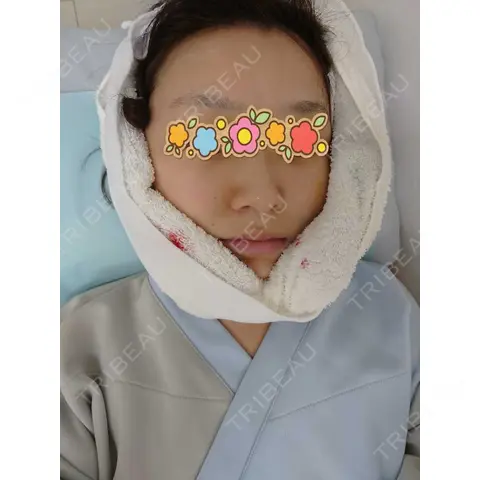 脂肪吸引（顔） / 切開リフト フェアクリニック川口 DAY 0