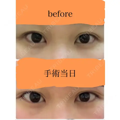 目尻切開 サラ美容外科 DAY 0