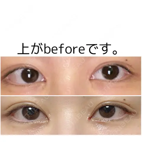 蒙古ひだ形成 R.O.clinic DAY 0