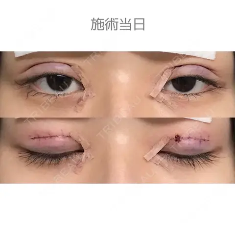 二重切開 / 目頭切開 / 上まぶたたるみ取り サラ美容外科 DAY 0