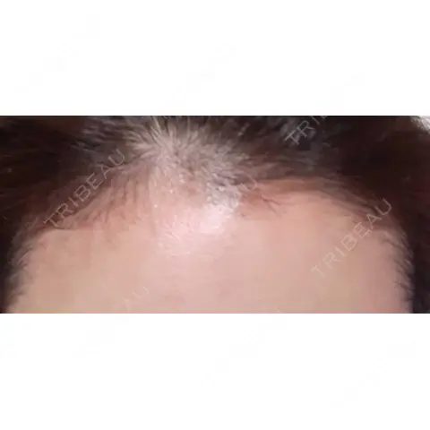 アートメイク（ヘアライン） トイトイトイクリニック 池袋院 AFTER