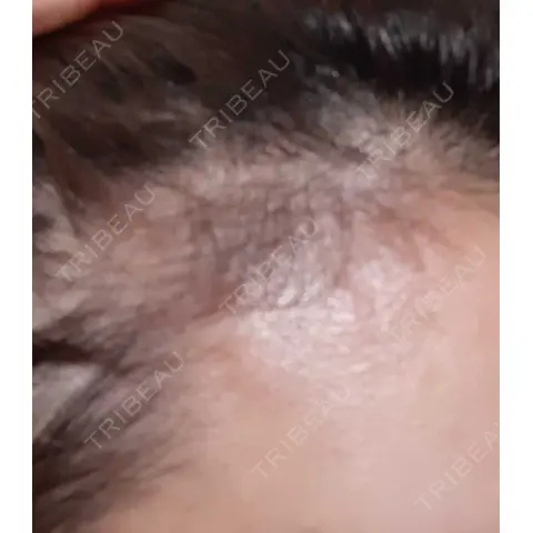 アートメイク（ヘアライン） トイトイトイクリニック 池袋院 AFTER