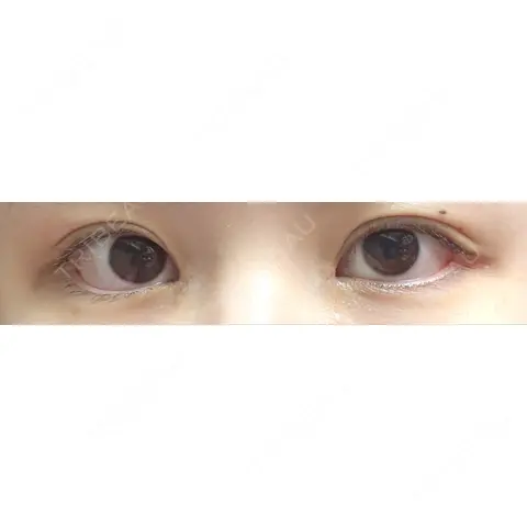 蒙古ひだ形成 R.O.clinic AFTER