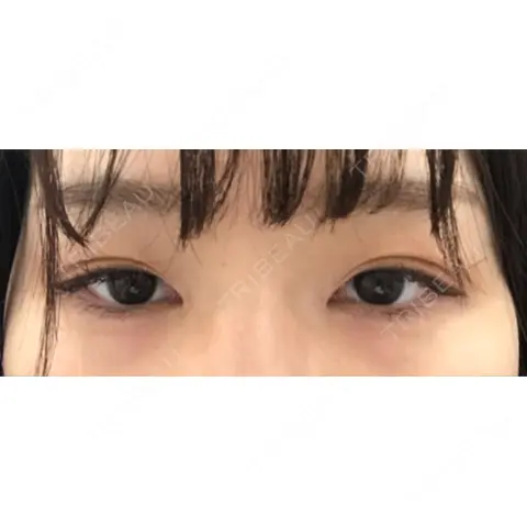 ヒアルロン酸注入（涙袋） フィラークリニック 横浜院 DAY 1