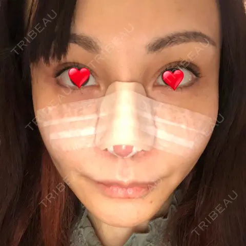 隆鼻術 / 鼻尖形成（切開） / 鼻中隔延長（切開） / 軟骨移植 / プロテーゼ除去 / 鼻修正 THE ROPPONGI CLINIC（ザ 六本木クリニック） DAY 0