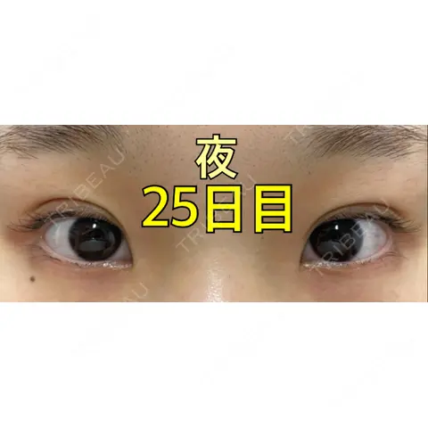 二重埋没 ながしまクリニック AFTER
