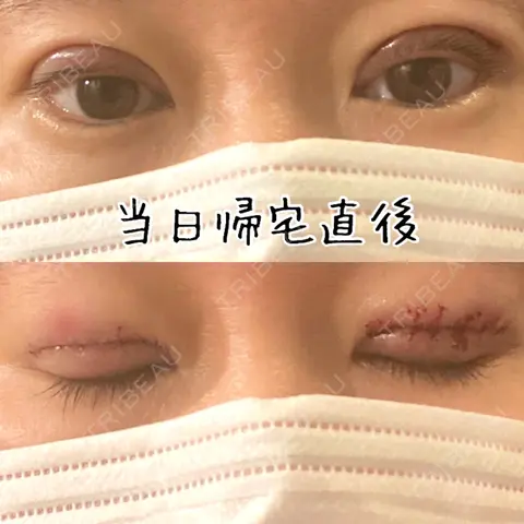 二重切開 蘇春堂形成外科 DAY 0