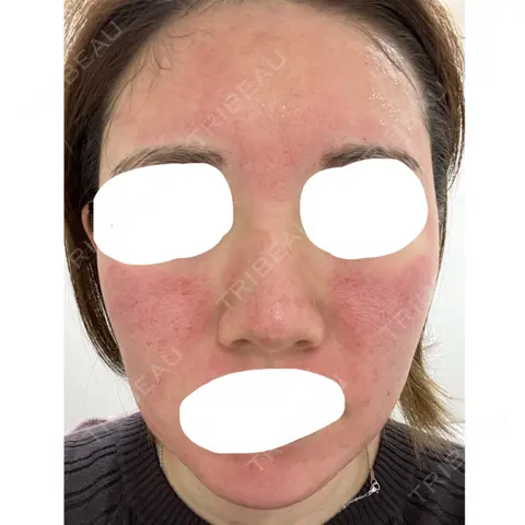 ダーマペン VENUS BEAUTY CLINIC　銀座院 DAY 0