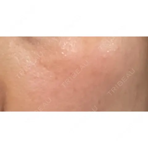シミ取りレーザー / ピコレーザートーニング（美白・肝斑） PICO BEAUTY CLINIC AFTER