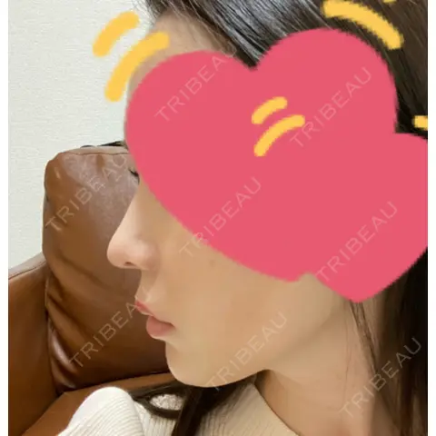 小鼻縮小（切開） / 鼻翼基部形成（貴族手術） 新宿ラクル美容外科クリニック 新宿院 AFTER