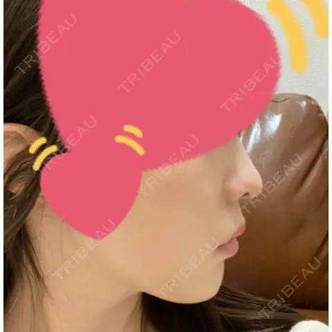 小鼻縮小（切開） / 鼻翼基部形成（貴族手術） 新宿ラクル美容外科クリニック 新宿院 AFTER