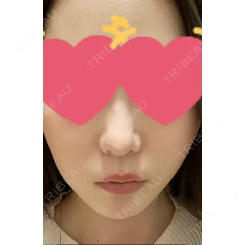 小鼻縮小（切開） / 鼻翼基部形成（貴族手術） 新宿ラクル美容外科クリニック 新宿院 AFTER