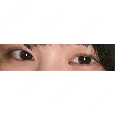 蒙古ひだ形成 R.O.clinic AFTER