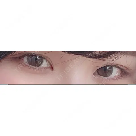 蒙古ひだ形成 R.O.clinic AFTER