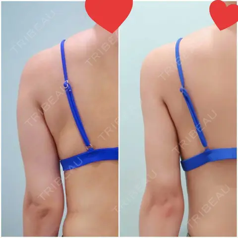 脂肪吸引（二の腕） WOM CLINIC GINZA （ワム クリニック ギンザ） AFTER