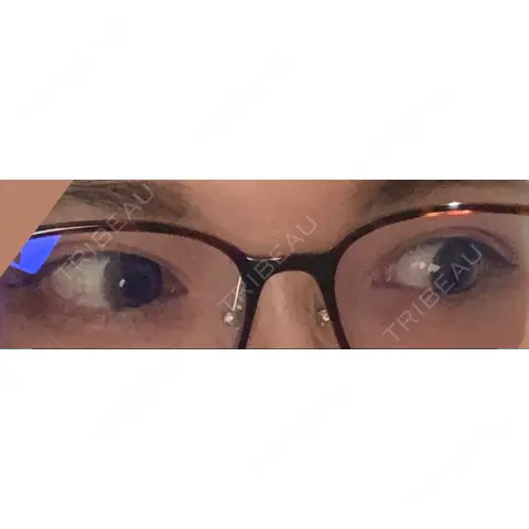 目頭切開 OZI SKIN CLINIC（オジスキンクリニック） AFTER