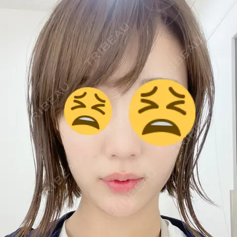 ボトックス（エラ・小顔） 品川美容外科 品川院 DAY 3